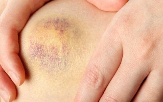 Μελανιάζεις εύκολα; Μάθε τον λόγο!