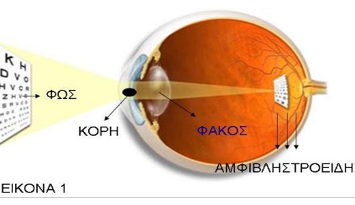 Το “καθημερινό θαύμα” της επέμβασης του καταρράκτη - ΒΙΝΤΕΟ