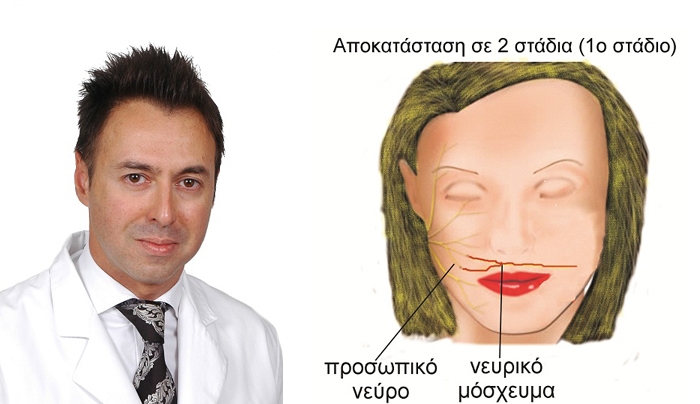 Τέλος στη χρόνια παράλυση προσώπου βάζει η επανορθωτική πλαστική μικροχειρουργική